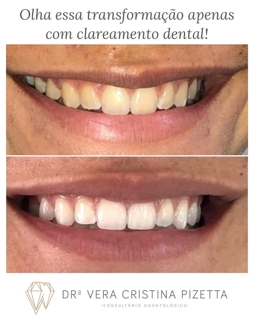 Antes e depois de clareamento dental — sorriso mais branco